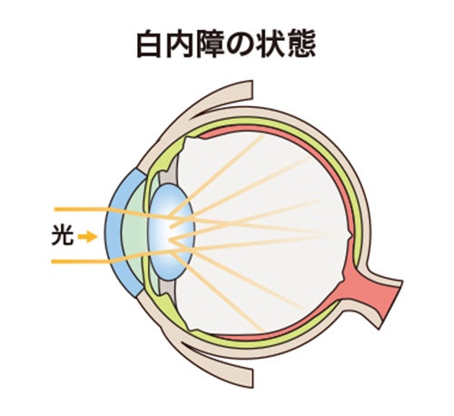 白内障の眼の状態を示したイラスト